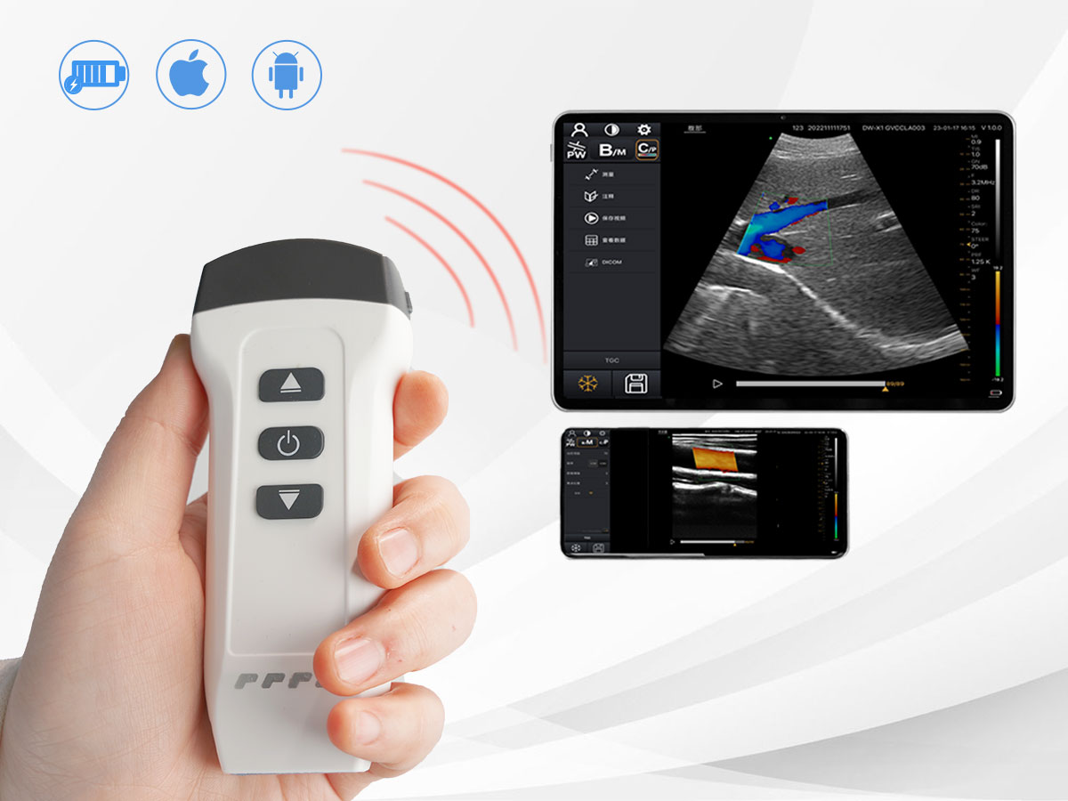 https://www.ultrasounddawei.com/news/choosing-the-right-wireless-handheld-ultrasound-scanner
